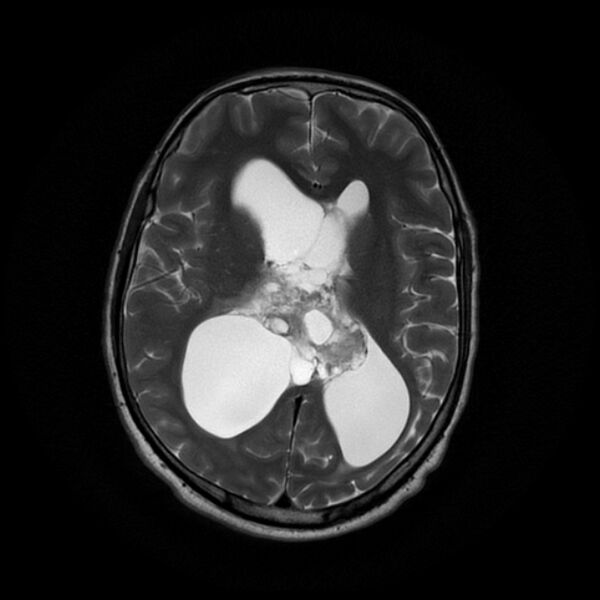 File:Central neurocytoma (Radiopaedia 67618-77021 Axial T2 14).jpg