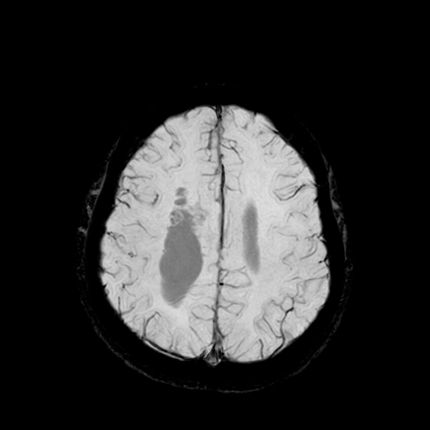 Central neurocytoma (Radiopaedia 79320-92380 Axial SWI 105).jpg