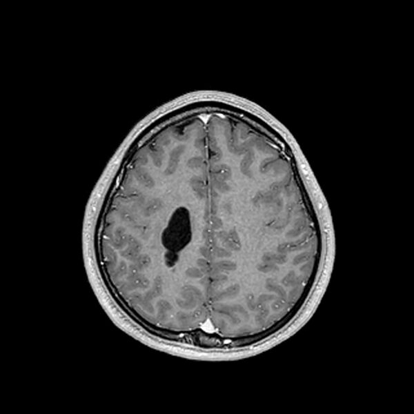 File:Central neurocytoma (Radiopaedia 79320-92380 Axial T1 C+ 177).jpg
