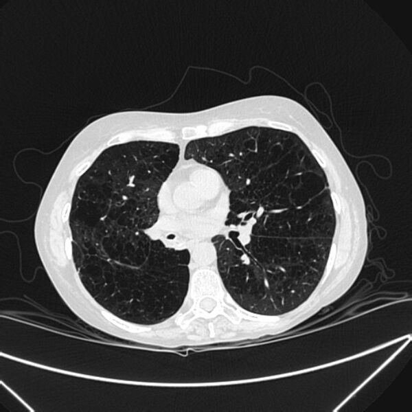 File:Centrilobular pulmonary emphysema (Radiopaedia 24495-24789 Axial lung window 51).jpg