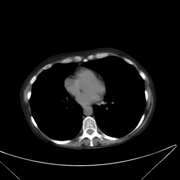 File:Centrilobular pulmonary emphysema (Radiopaedia 24495-24789 Axial non-contrast 31).jpg