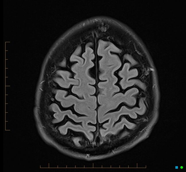 File:Cerebellar gangliocytoma (Radiopaedia 65377-74422 Axial FLAIR 33).jpg