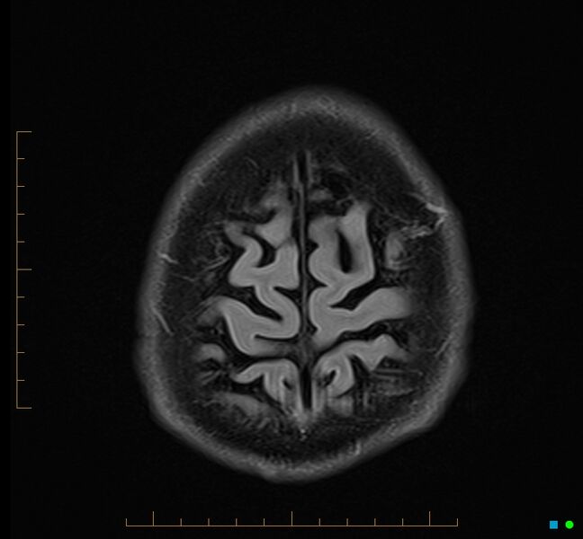 File:Cerebellar gangliocytoma (Radiopaedia 65377-74422 Axial FLAIR 36).jpg