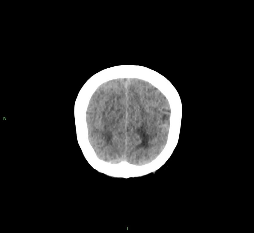 Cerebellar hemorrhage (Radiopaedia 58793-66027 Coronal non-contrast 13).jpg