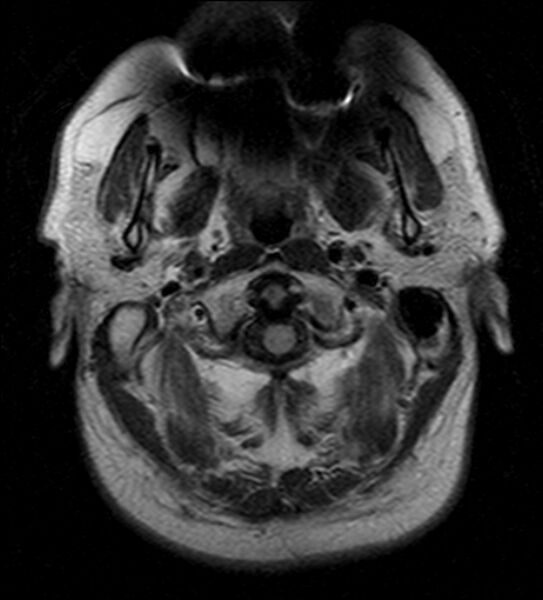 File:Cerebellopontine angle meningioma (Radiopaedia 24459-24764 Axial FLAIR 1).jpg