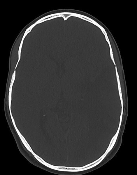 File:Cerebral abscesses (Radiopaedia 70458-80568 Axial bone window 32).jpg