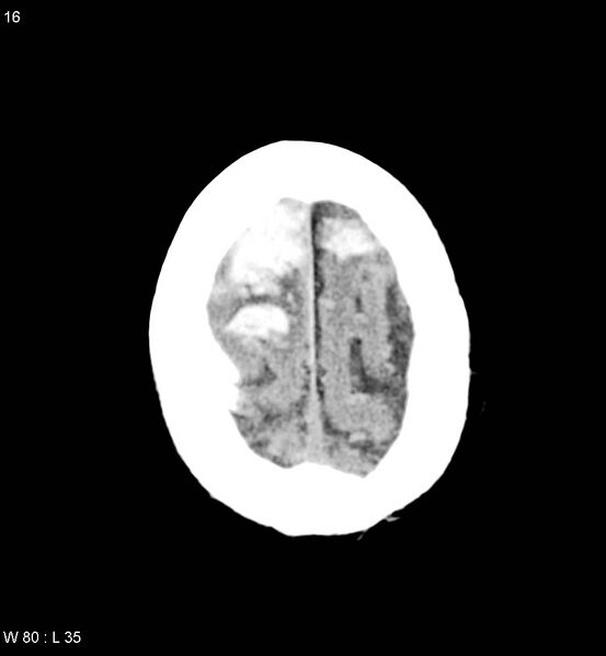 File:Cerebral abscesses secondary to contusions (Radiopaedia 5201-22213 Axial non-contrast 9).jpg