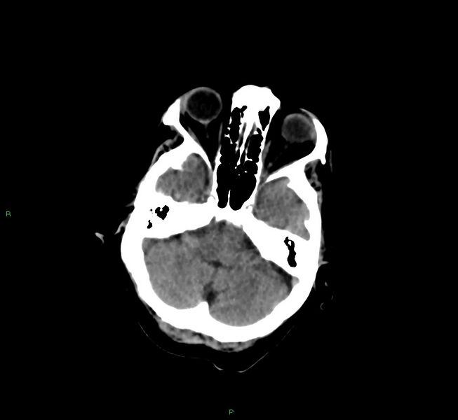 File:Cerebral amyloid angiopathy-associated lobar intracerebral hemorrhage (Radiopaedia 58377-65514 Axial non-contrast 38).jpg