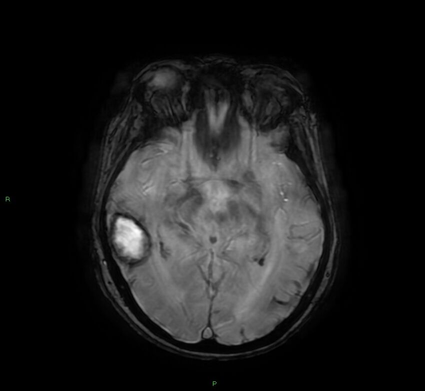 Cerebral amyloid angiopathy-associated lobar intracerebral hemorrhage (Radiopaedia 58378-65517 Axial SWI 32).jpg