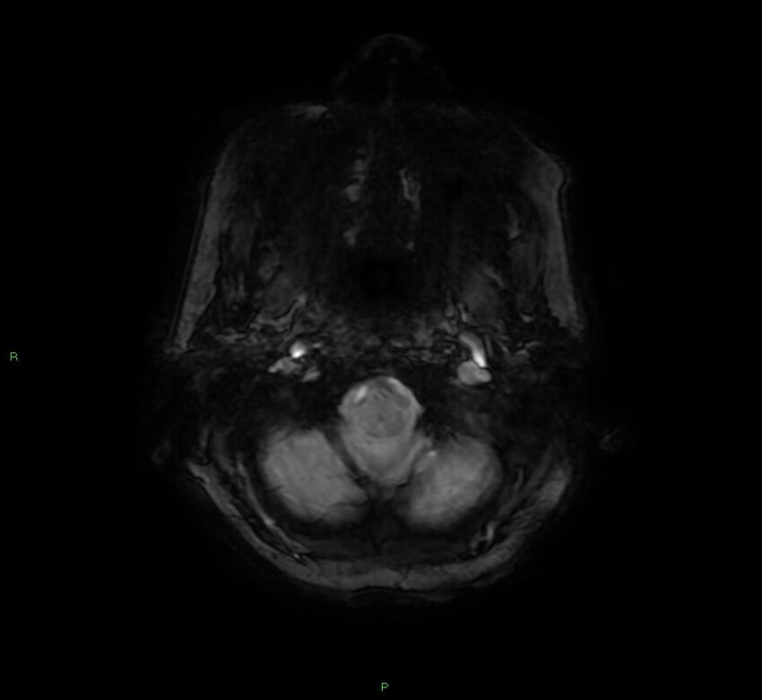 Cerebral amyloid angiopathy-associated lobar intracerebral hemorrhage (Radiopaedia 58378-65517 Axial SWI 7).jpg