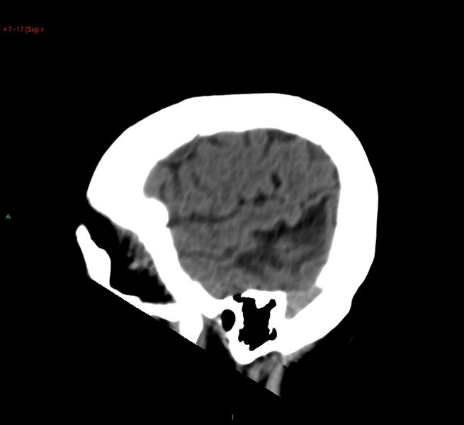 File:Cerebral amyloid angiopathy-associated lobar intracerebral hemorrhage (Radiopaedia 58378-65518 C 17).jpg