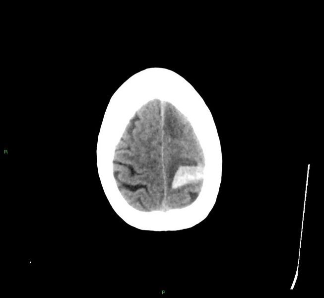 File:Cerebral amyloid angiopathy-associated lobar intracerebral hemorrhage (Radiopaedia 58529-65681 Axial non-contrast 8).jpg
