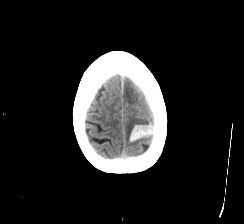 Cerebral amyloid angiopathy-associated lobar intracerebral hemorrhage (Radiopaedia 58529-65681 Axial non-contrast 8).jpg