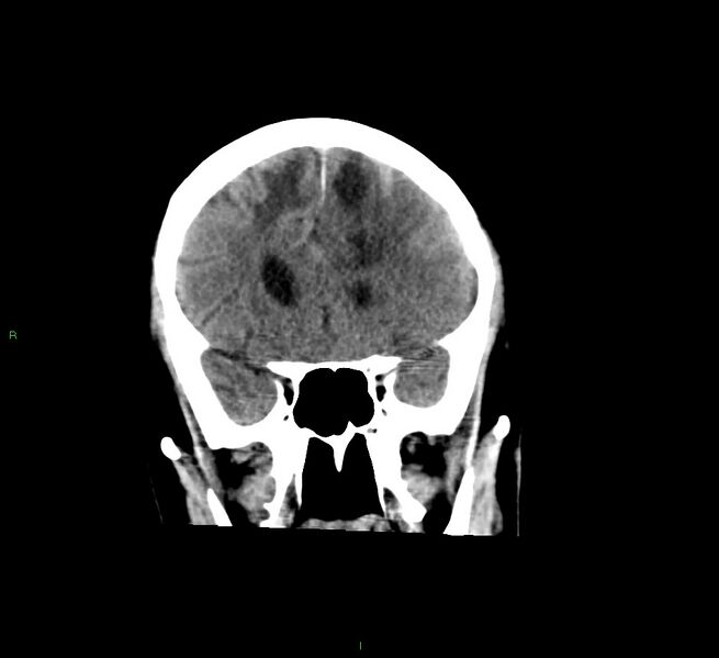 File:Cerebral amyloid angiopathy-associated lobar intracerebral hemorrhage (Radiopaedia 58529-65681 Coronal non-contrast 46).jpg