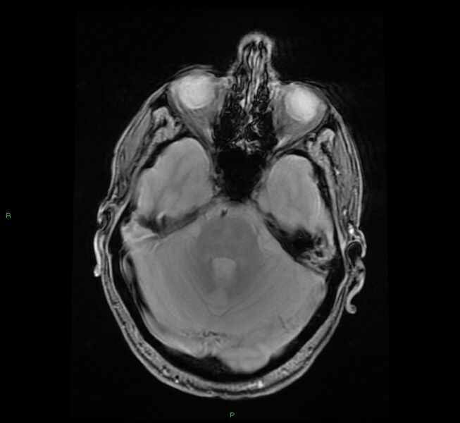 File:Cerebral amyloid angiopathy-associated lobar intracerebral hemorrhage (Radiopaedia 58529-65684 Axial Gradient Echo 8).jpg