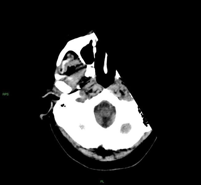 File:Cerebral amyloid angiopathy-associated lobar intracerebral hemorrhage (Radiopaedia 58569-65734 Axial non-contrast 51).jpg