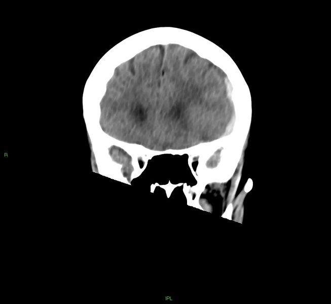 File:Cerebral amyloid angiopathy-associated lobar intracerebral hemorrhage (Radiopaedia 58754-65975 Coronal non-contrast 44).jpg