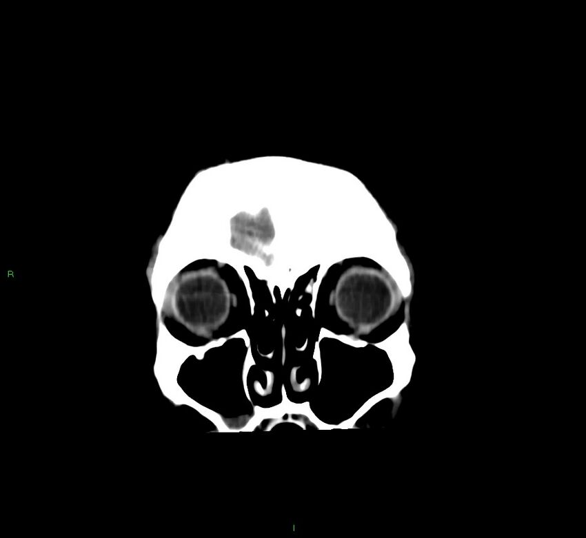 Cerebral amyloid angiopathy-associated lobar intracerebral hemorrhage (Radiopaedia 58756-65977 Coronal non-contrast 57).jpg
