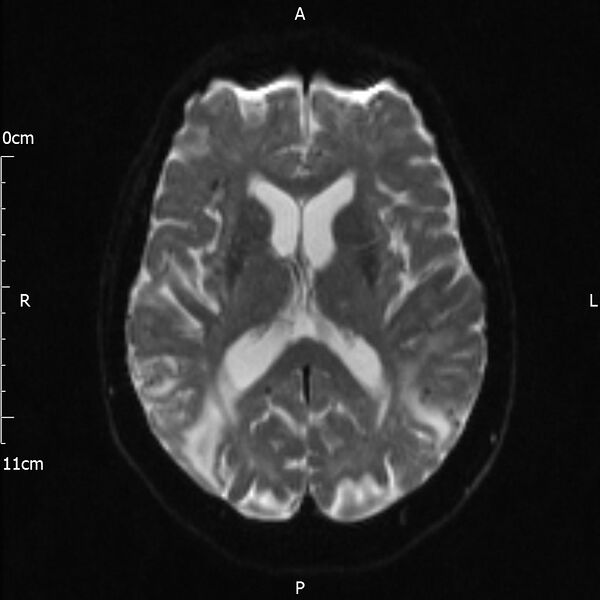 File:Cerebral amyloid angiopathy related inflammation (Radiopaedia 72772-83415 Axial DWI 13).jpg