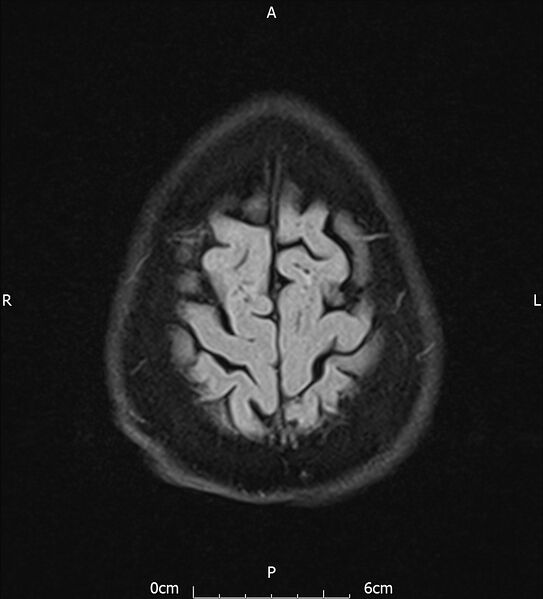 File:Cerebral amyloid angiopathy related inflammation (Radiopaedia 72772-83415 Axial FLAIR 21).jpg