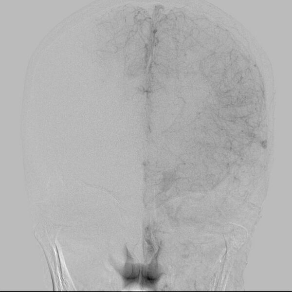 File:Cerebral aneurysm with rupture (Radiopaedia 29933-30458 LT CCA IC 19).jpg