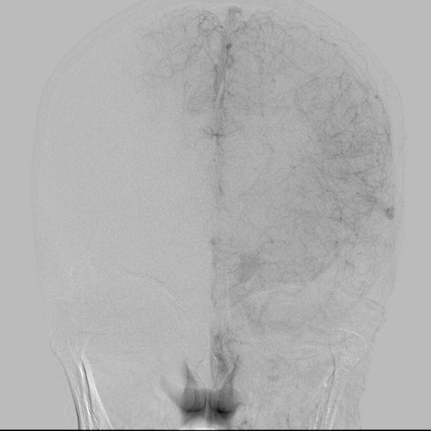 Cerebral aneurysm with rupture (Radiopaedia 29933-30458 LT CCA IC 19).jpg