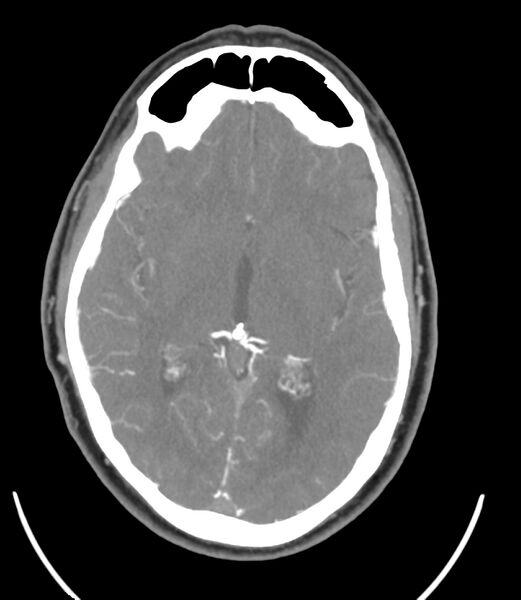 File:Cerebral dural venous sinus thrombosis (Radiopaedia 86514-102576 A 54).jpg
