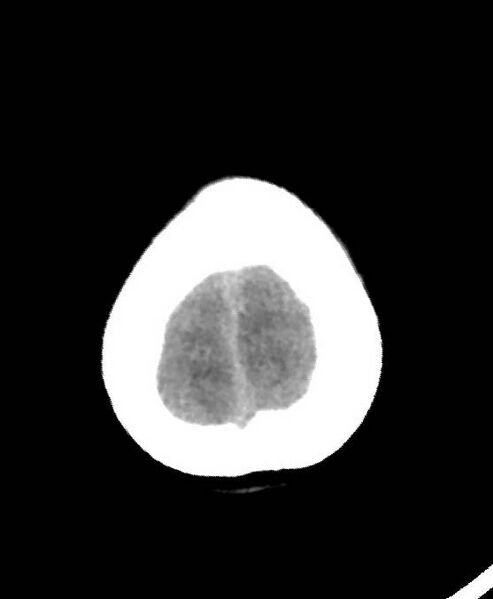 File:Cerebral edema due to severe hyponatremia (Radiopaedia 89826-106937 Axial non-contrast 87).jpg