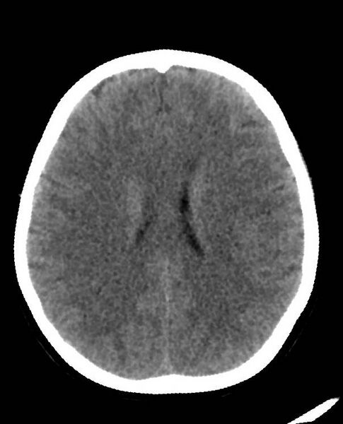 File:Cerebral edema due to severe hyponatremia (Radiopaedia 89826-106938 Axial non-contrast 64).jpg