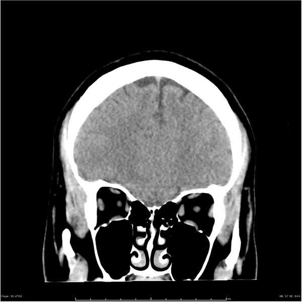 File:Cerebral hemorrhage secondary to arteriovenous malformation (Radiopaedia 33497-34561 Coronal non-contrast 7).jpg