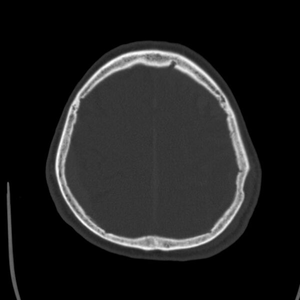 File:Cerebral hemorrhagic contusions (Radiopaedia 23145-23188 Axial bone window 46).jpg