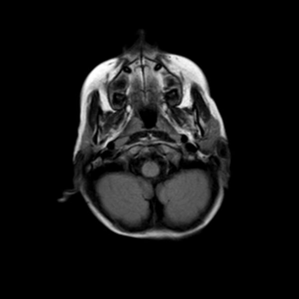 File:Cerebral tuberculoma (Radiopaedia 41152-43932 Axial FLAIR 2).jpg
