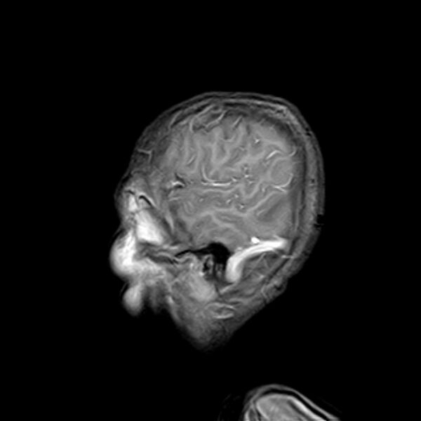File:Cerebral tuberculoma (Radiopaedia 41152-43932 Sagittal T1 C+ 17).jpg