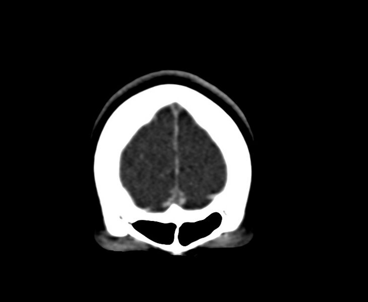 File:Cerebral venous sinus thrombosis (Radiopaedia 59224-66646 Coronal C+ delayed 3).jpg