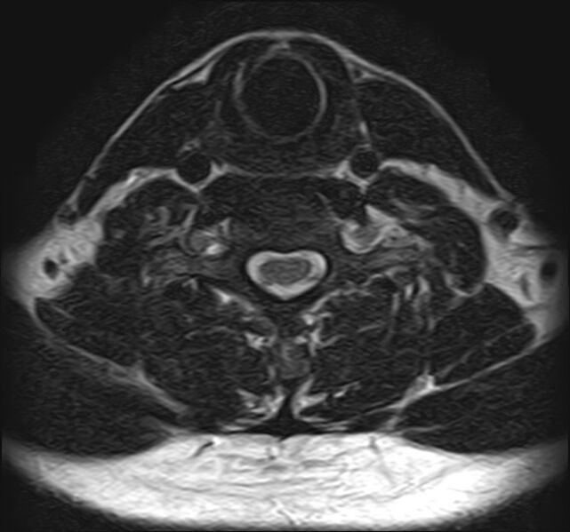 File:Cervical compressive myelopathy (Radiopaedia 71956-82411 Axial T2 12).jpg