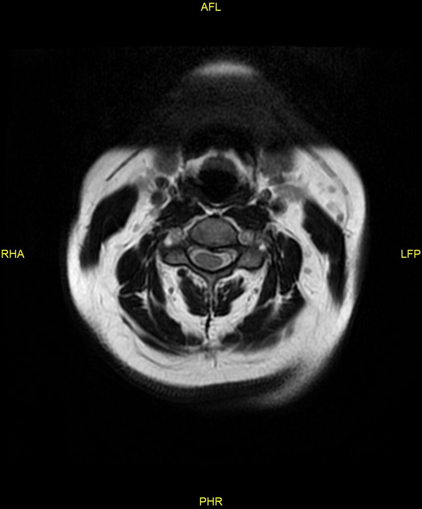 Cervical disc protrusion (Radiopaedia 87147-103415 Axial T2 2).jpg