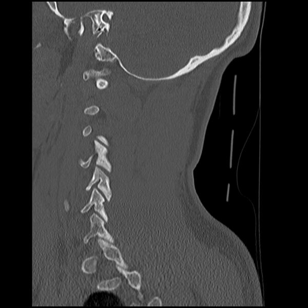 File:Cervical flexion teardrop fracture with cord hemorrhage (Radiopaedia 32497-33454 Sagittal bone window 36).jpg
