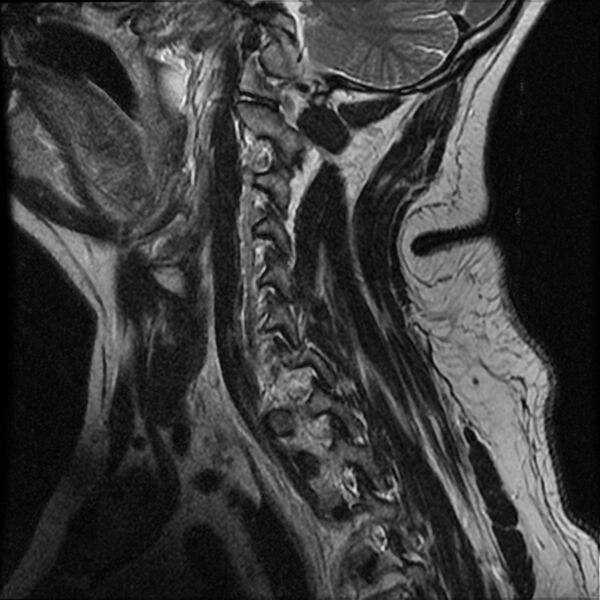 File:Cervical fracture and dislocation with locked facet (Radiopaedia 31837-32781 Sagittal T2 13).jpg