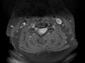 Cervical schwannoma (Radiopaedia 72399-82934 Axial T1 C+ fat sat 8).jpg
