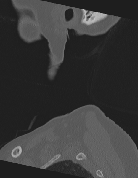 File:Cervical spine ACDF loosening (Radiopaedia 48998-54071 Sagittal bone window 2).png