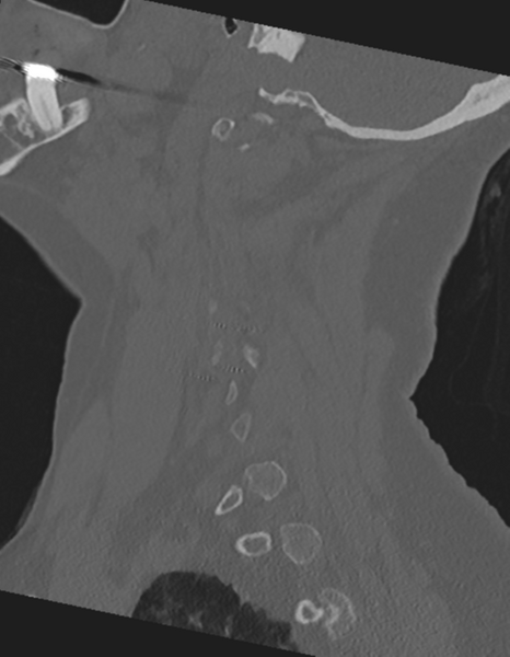 File:Cervical spine ACDF loosening (Radiopaedia 48998-54071 Sagittal bone window 25).png