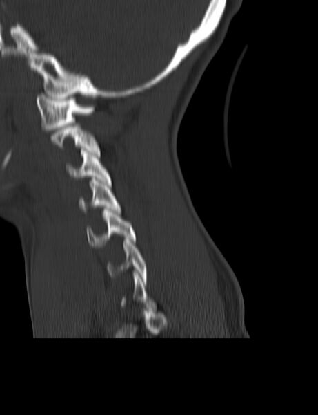File:Cervical spine posterior ligamentous complex rupture (Radiopaedia 63486-72101 Sagittal bone window 21).jpg