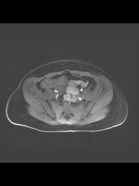 File:Cesarean section scar endometrioma (Radiopaedia 56569-63297 Axial T1 C+ fat sat 34).jpg