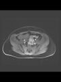Cesarean section scar endometrioma (Radiopaedia 56569-63297 Axial T1 C+ fat sat 34).jpg