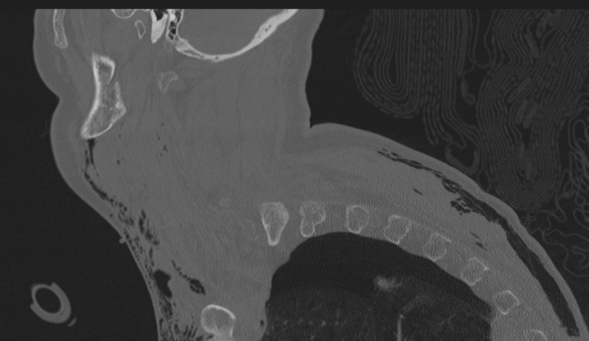 Chalk stick fracture (Radiopaedia 57948-64928 Sagittal bone window 6).png