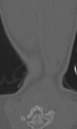 Chance fracture (Radiopaedia 40360-42912 Coronal bone window 69).png