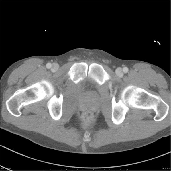 File:Chest and abdomen multi-trauma (Radiopaedia 26294-26426 bone window 88).jpg