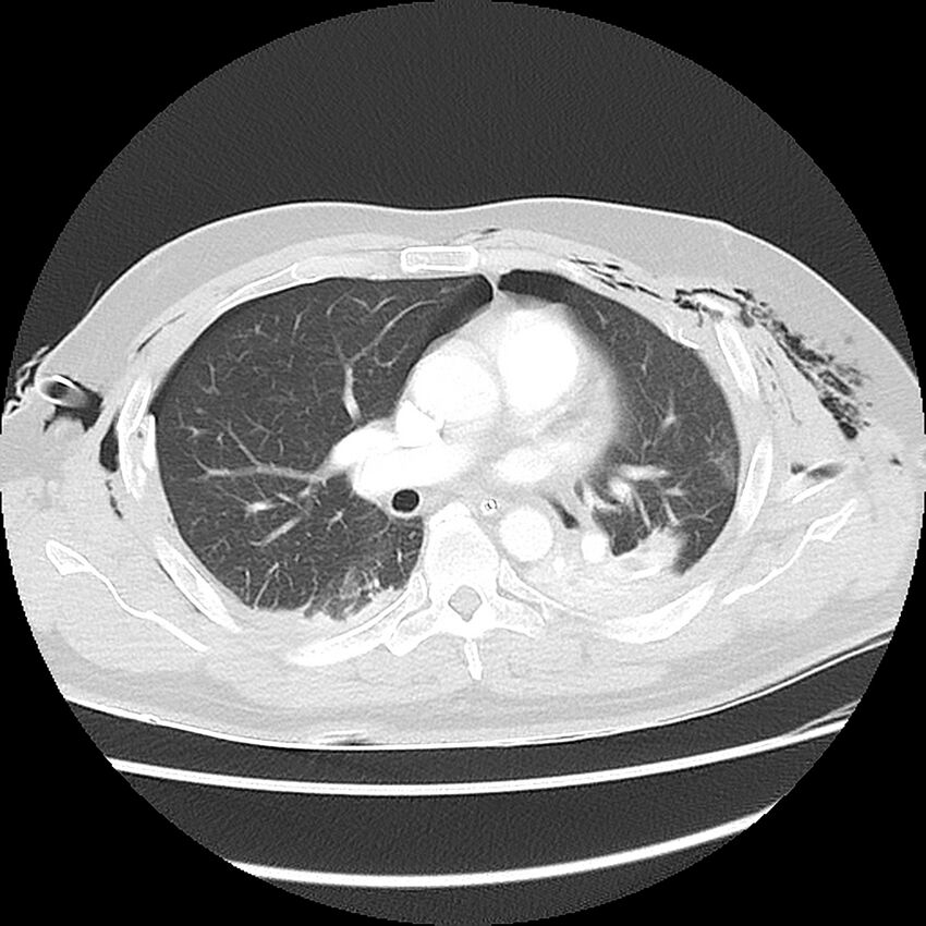Chest crush injury (Radiopaedia 31620-32513 Axial lung window 28).jpg