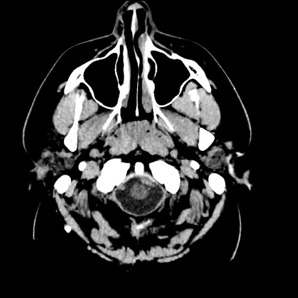 File:Chiasmatic-hypothalamic juvenile pilocytic astrocytoma (Radiopaedia 78533-91237 Axial non-contrast 7).jpg