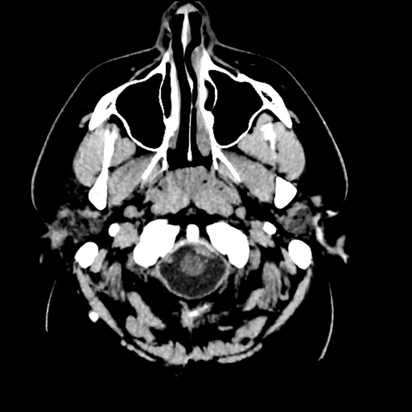 Chiasmatic-hypothalamic juvenile pilocytic astrocytoma (Radiopaedia 78533-91237 Axial non-contrast 7).jpg
